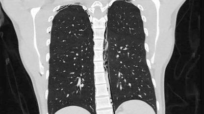 Rayos X, Imágenes médicas Película de rayos X, Tomografía computarizada